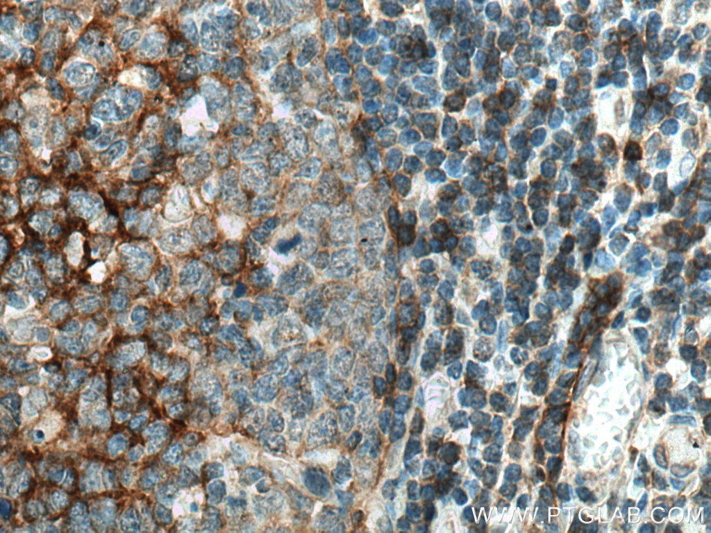 Immunohistochemistry (IHC) staining of human tonsillitis tissue using NT5E,CD73 Monoclonal antibody (67789-1-Ig)