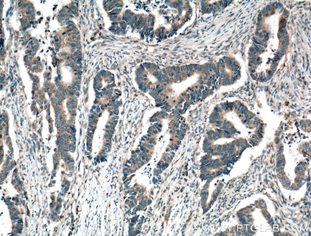 Immunohistochemistry (IHC) staining of human colon cancer tissue using ARK5 Polyclonal antibody (22723-1-AP)