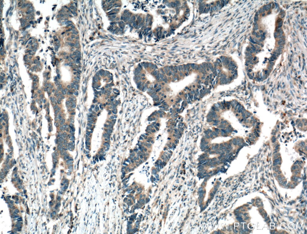 IHC staining of human colon cancer using 22723-1-AP