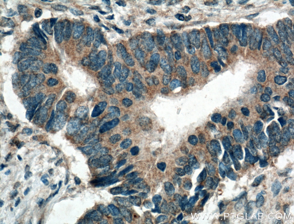 Immunohistochemistry (IHC) staining of human colon cancer tissue using ARK5 Polyclonal antibody (22723-1-AP)