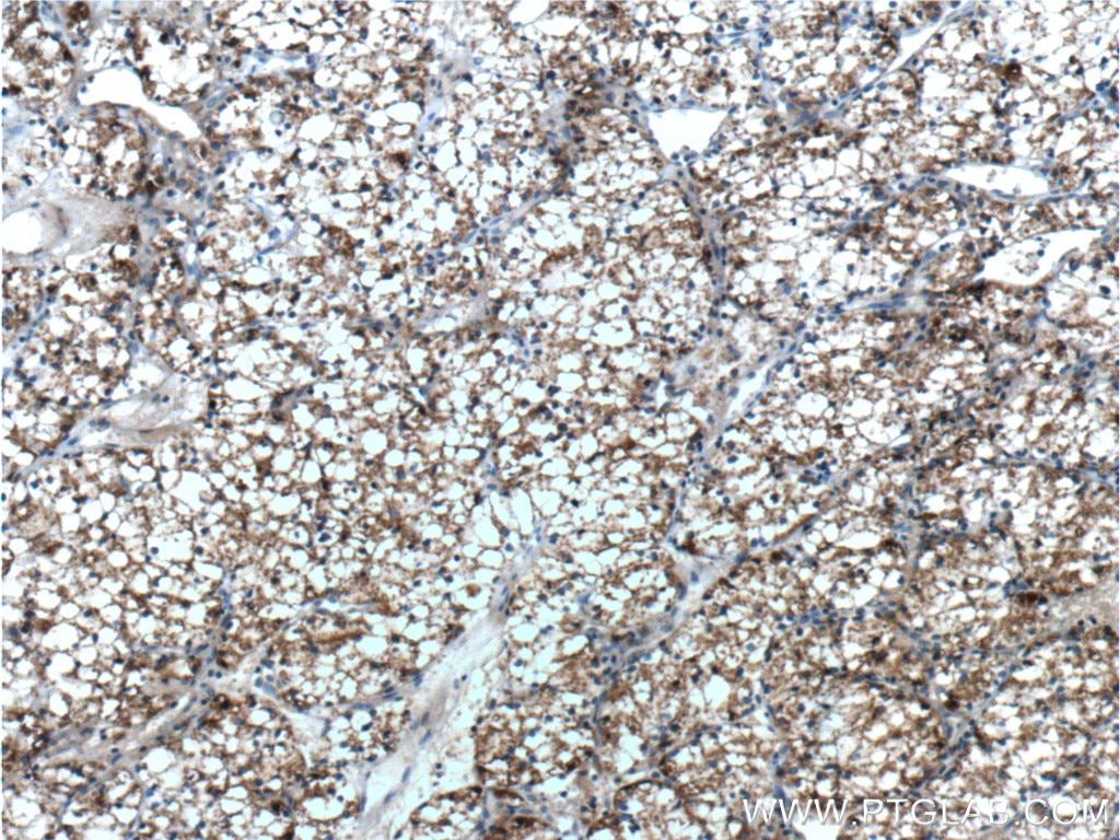 Immunohistochemistry (IHC) staining of human renal cell carcinoma tissue using NUAK2 Polyclonal antibody (11592-1-AP)