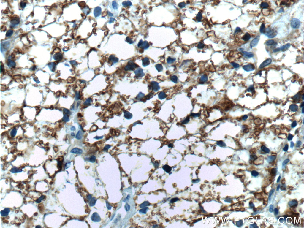 Immunohistochemistry (IHC) staining of human renal cell carcinoma tissue using NUAK2 Polyclonal antibody (11592-1-AP)