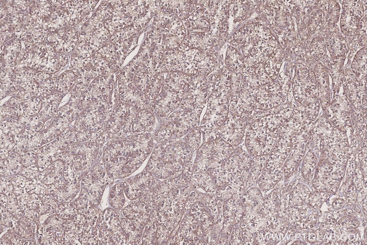 IHC staining of human renal cell carcinoma using 18011-1-AP Immunohistochemistry (IHC) staining of human renal cell carcinoma tissue using NUBP1 Polyclonal antibody (18011-1-AP)