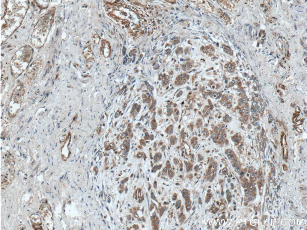 Immunohistochemistry (IHC) staining of human colon cancer tissue using NUBPL Polyclonal antibody (17393-1-AP)