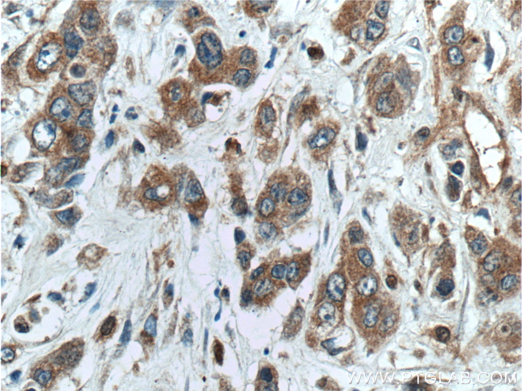 Immunohistochemistry (IHC) staining of human colon cancer tissue using NUBPL Polyclonal antibody (17393-1-AP)