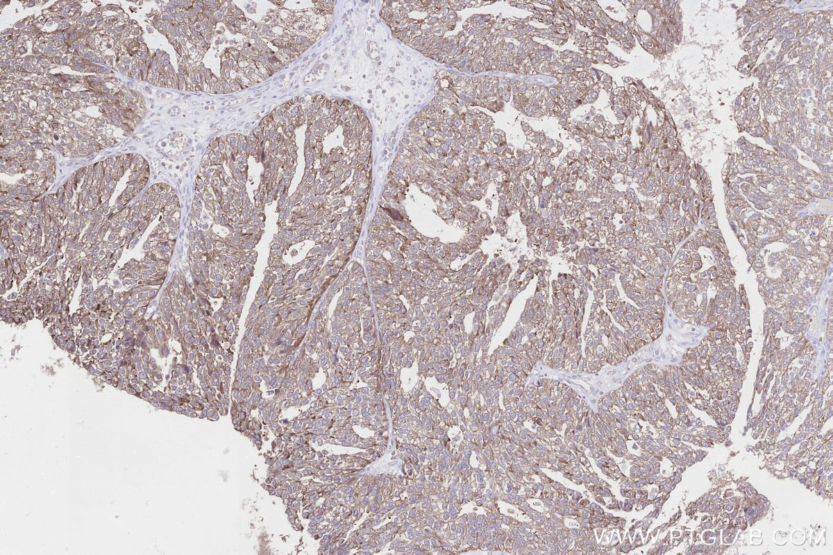 Immunohistochemistry (IHC) staining of human ovary cancer tissue using NUBPL Polyclonal antibody (17393-1-AP)