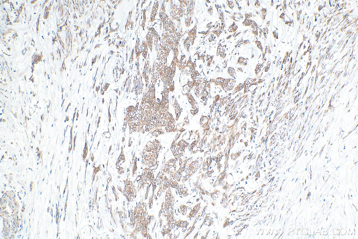 Immunohistochemistry (IHC) staining of human urothelial carcinoma tissue using NUCB2 Polyclonal antibody (30604-1-AP)