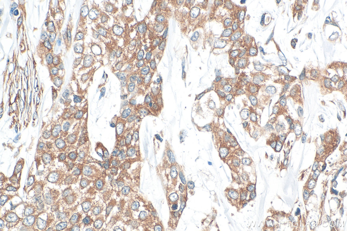 Immunohistochemistry (IHC) staining of human urothelial carcinoma tissue using NUCB2 Polyclonal antibody (30604-1-AP)