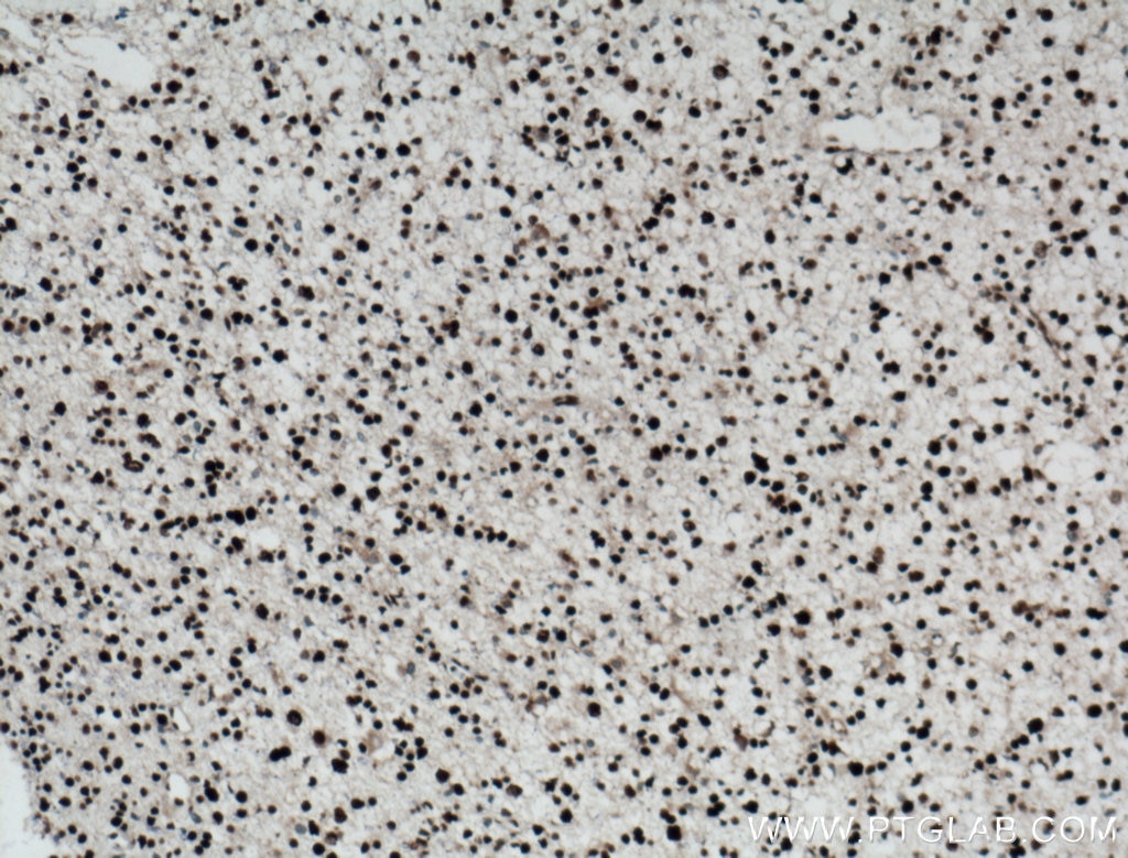 IHC staining of human gliomas using 12023-2-AP