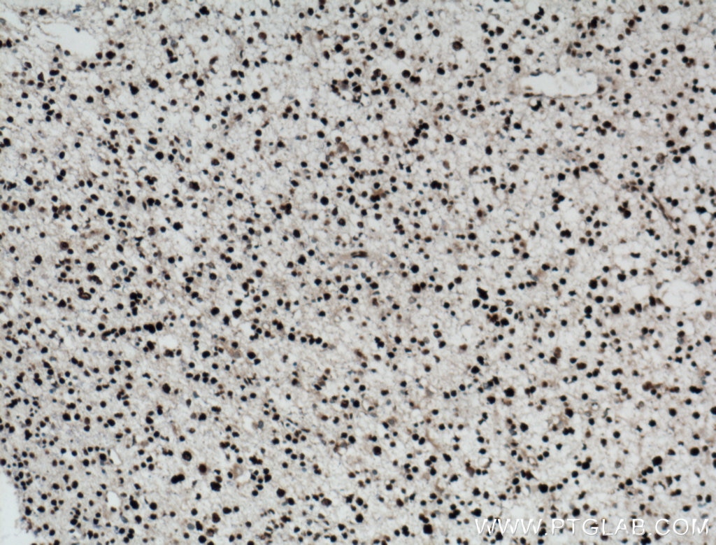 Immunohistochemistry (IHC) staining of human gliomas tissue using NUCKS1 Polyclonal antibody (12023-2-AP)