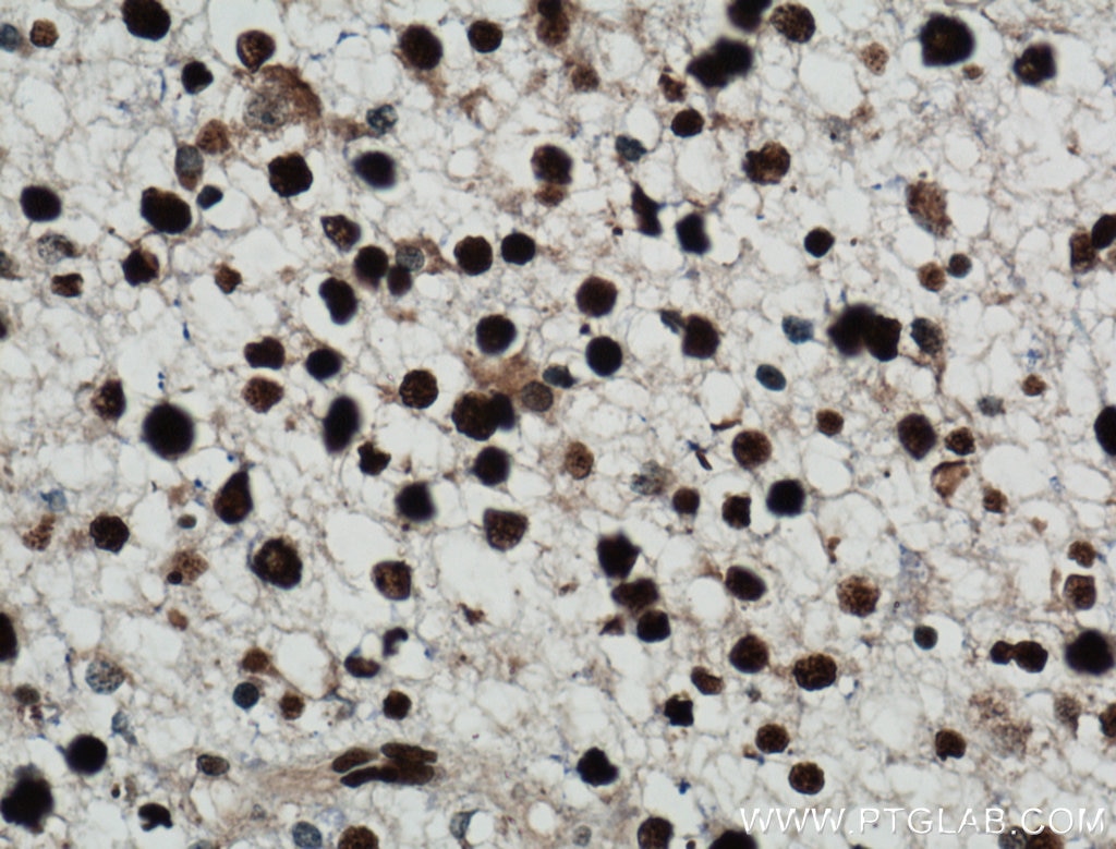 Immunohistochemistry (IHC) staining of human gliomas tissue using NUCKS1 Polyclonal antibody (12023-2-AP)