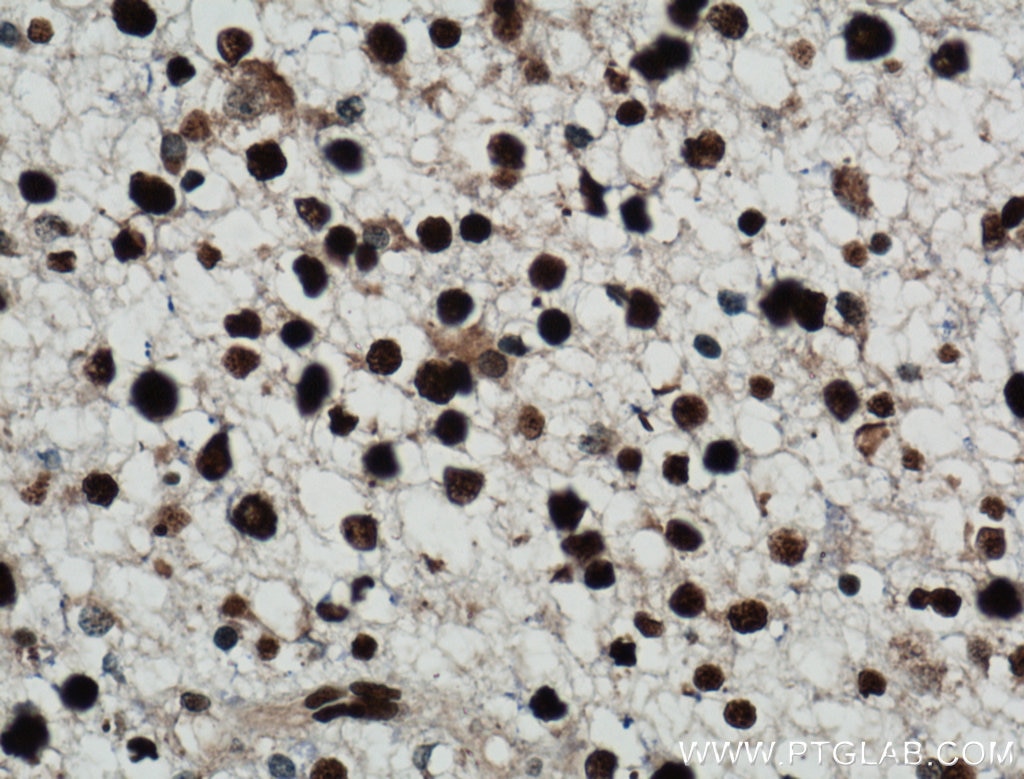 IHC staining of human gliomas using 12023-2-AP