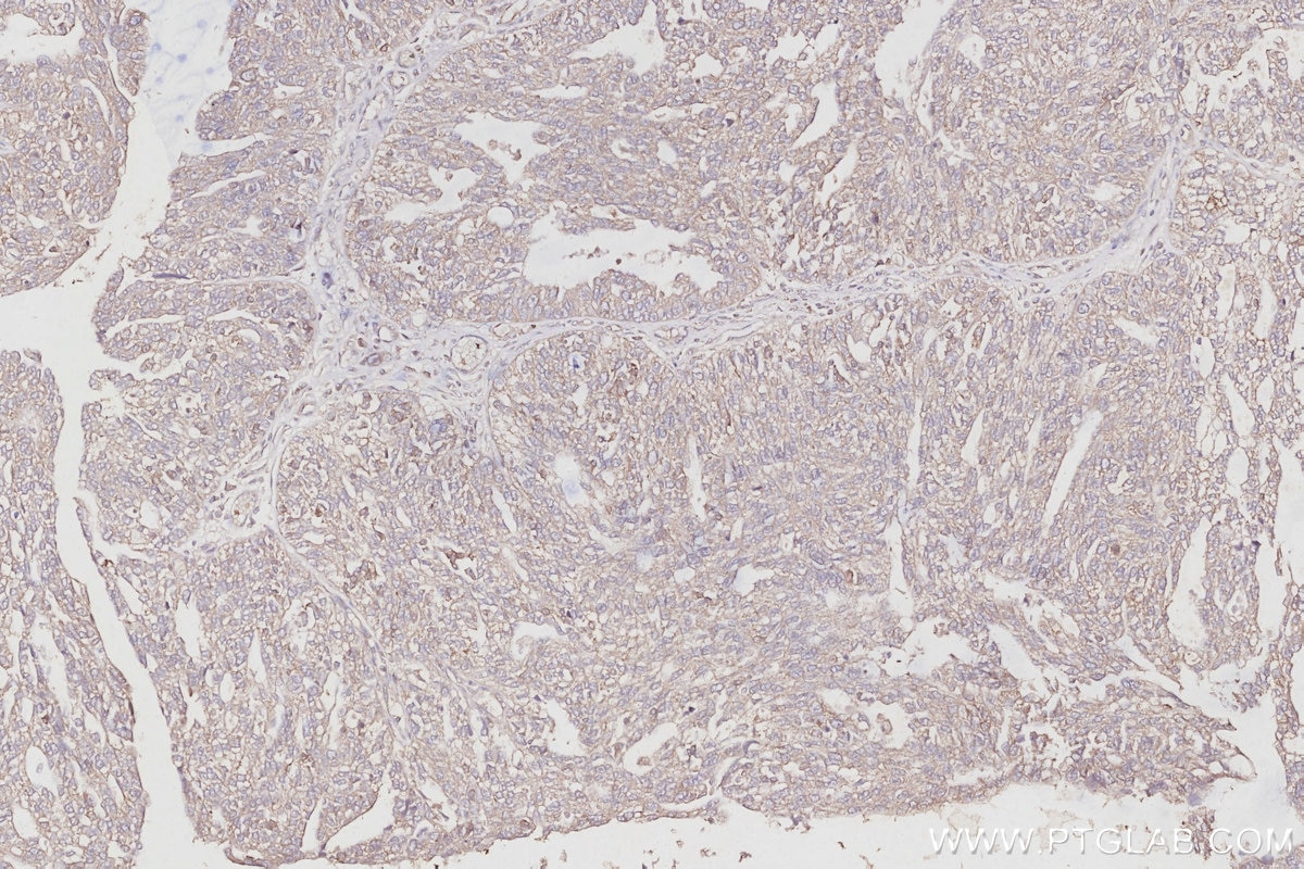 IHC staining of human ovary cancer using 10681-1-AP Immunohistochemistry (IHC) staining of human ovary cancer tissue using NUDC Polyclonal antibody (10681-1-AP)