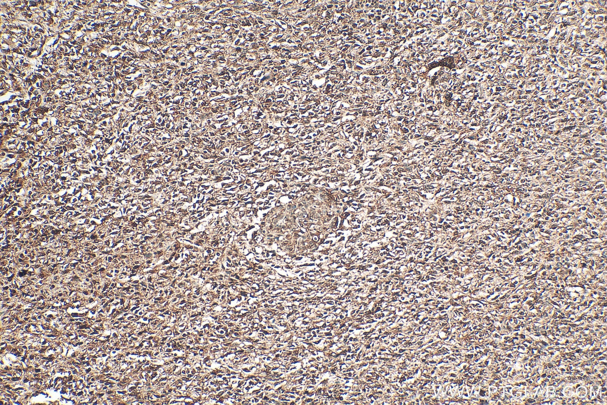 Immunohistochemistry (IHC) staining of human pancreas cancer tissue using NUDC Polyclonal antibody (10681-1-AP)