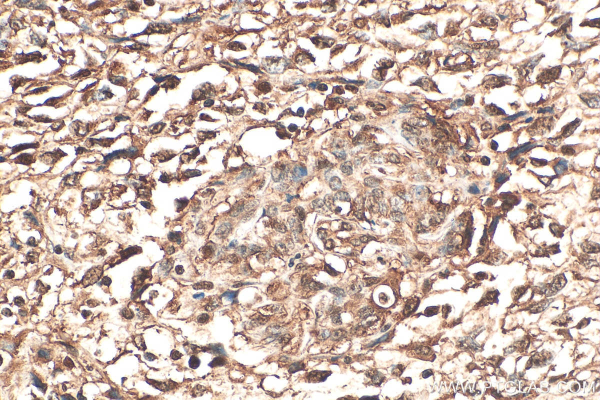 Immunohistochemistry (IHC) staining of human pancreas cancer tissue using NUDC Polyclonal antibody (10681-1-AP)