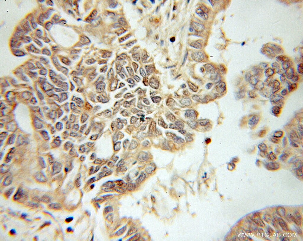 Immunohistochemistry (IHC) staining of human pancreas cancer tissue using NUDC Polyclonal antibody (10681-1-AP)
