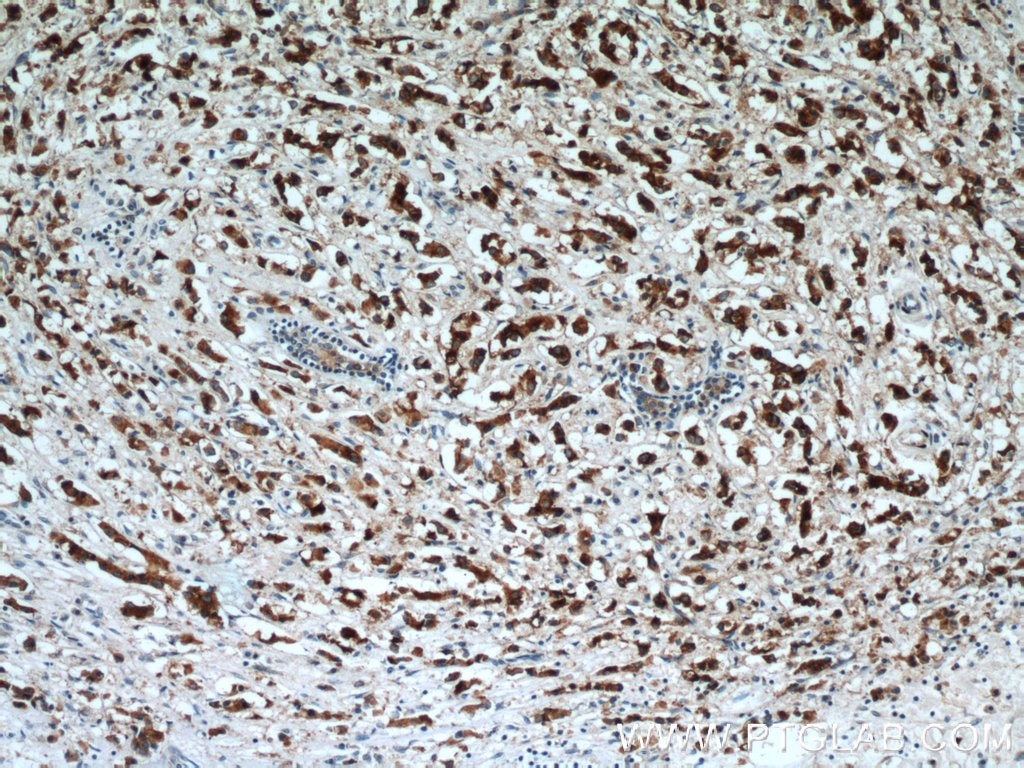 Immunohistochemistry (IHC) staining of human breast cancer tissue using NUDCD2 Polyclonal antibody (21205-1-AP)