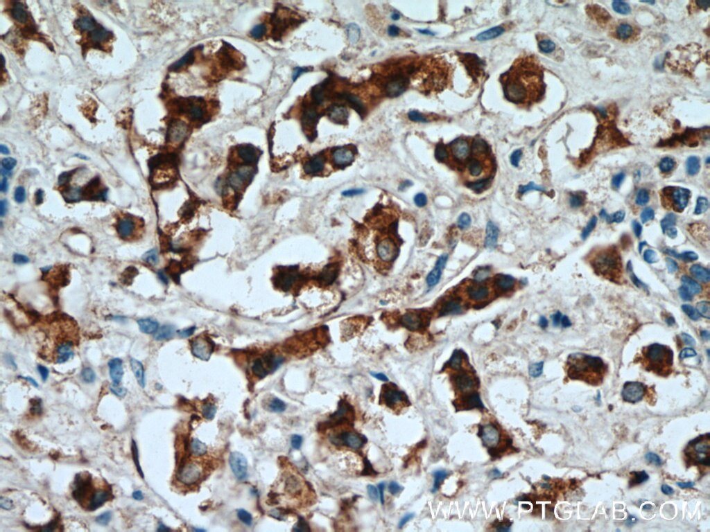 Immunohistochemistry (IHC) staining of human breast cancer tissue using NUDCD2 Polyclonal antibody (21205-1-AP)