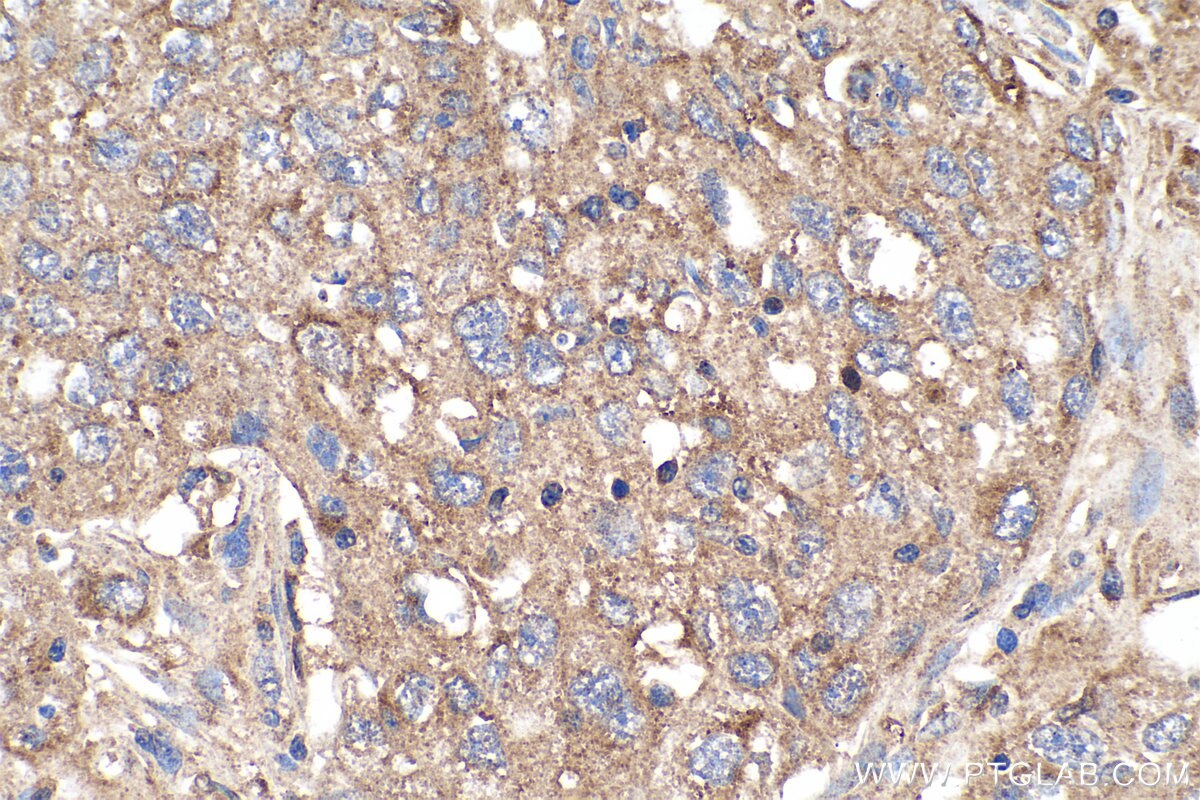 Immunohistochemistry (IHC) staining of human lung cancer tissue using MTH1 Polyclonal antibody (16705-1-AP)