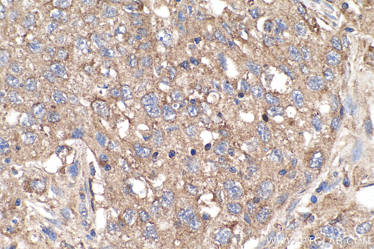 Immunohistochemistry (IHC) staining of human lung cancer tissue using MTH1 Polyclonal antibody (16705-1-AP)