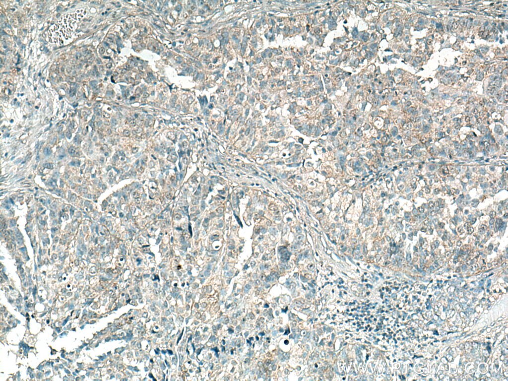 Immunohistochemistry (IHC) staining of human ovary tumor tissue using NUDT3/4/10/11 Polyclonal antibody (10912-1-AP)