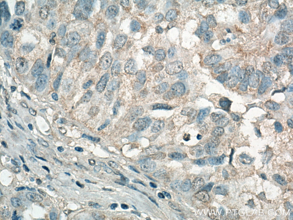 Immunohistochemistry (IHC) staining of human ovary tumor tissue using NUDT3/4/10/11 Polyclonal antibody (10912-1-AP)