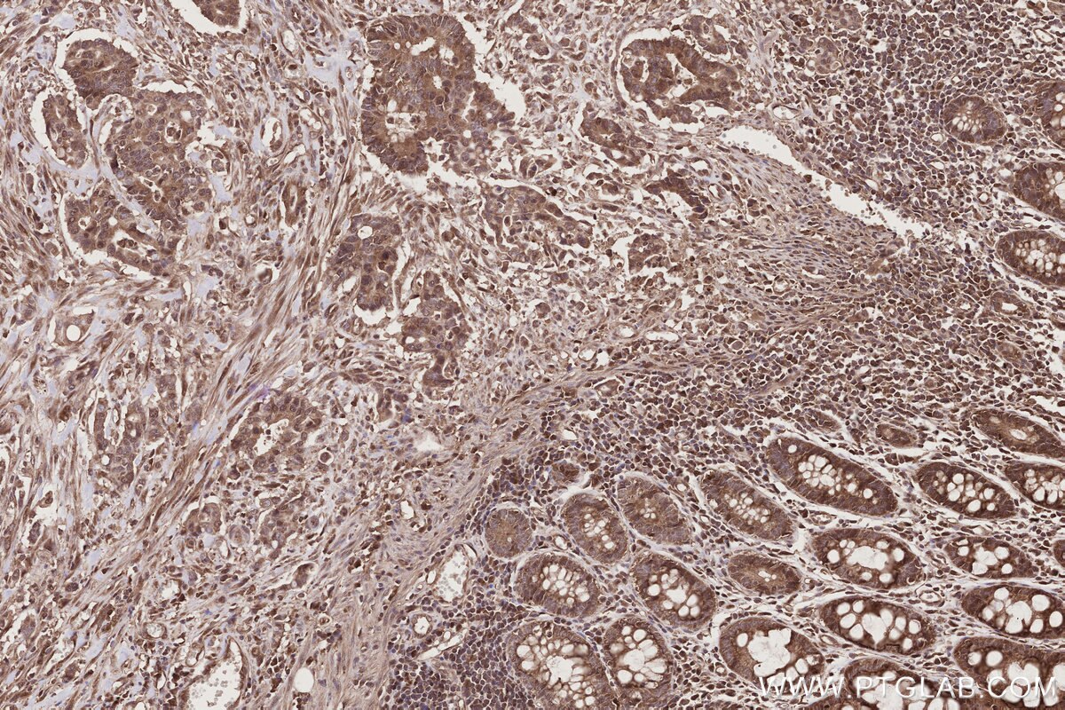 Immunohistochemistry (IHC) staining of human rectal cancer tissue using NUDT16 Polyclonal antibody (12889-1-AP)