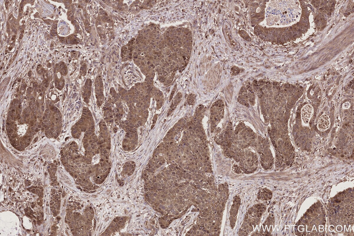 Immunohistochemistry (IHC) staining of human stomach cancer tissue using NUDT16 Polyclonal antibody (12889-1-AP)