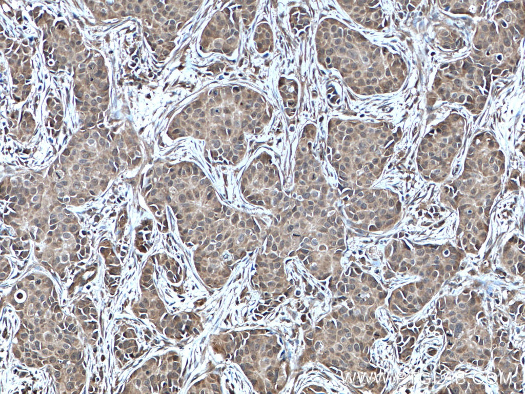 Immunohistochemistry (IHC) staining of human breast cancer tissue using NUDT2 Polyclonal antibody (10484-1-AP)