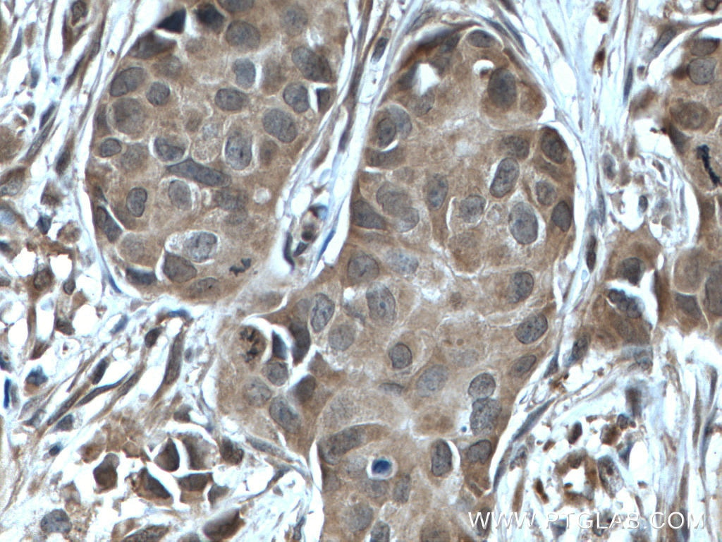 Immunohistochemistry (IHC) staining of human breast cancer tissue using NUDT2 Polyclonal antibody (10484-1-AP)