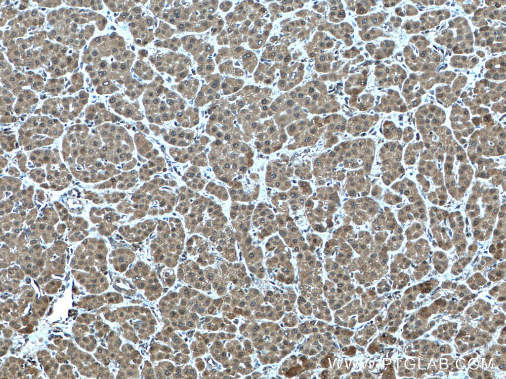 Immunohistochemistry (IHC) staining of human liver cancer tissue using NUDT2 Polyclonal antibody (10484-1-AP)