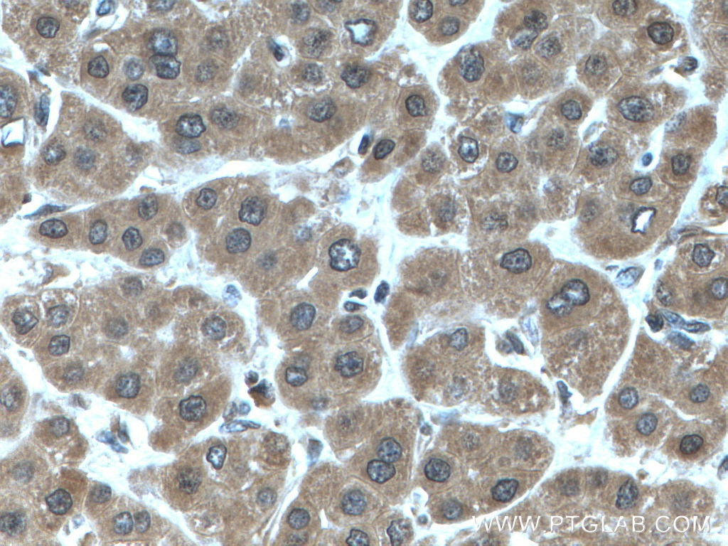 Immunohistochemistry (IHC) staining of human liver cancer tissue using NUDT2 Polyclonal antibody (10484-1-AP)