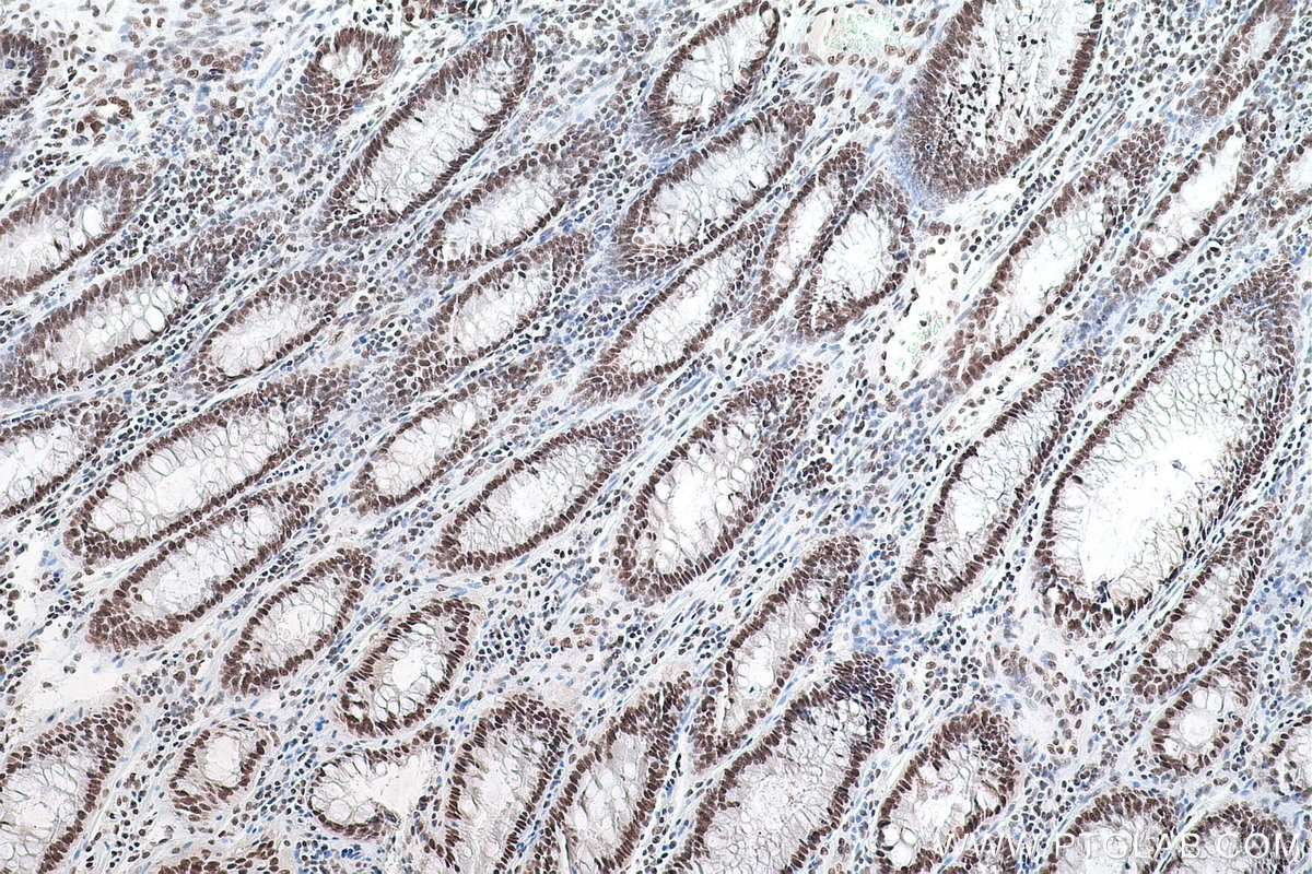 Immunohistochemistry (IHC) staining of human colon cancer tissue using NUDT21 Polyclonal antibody (10322-1-AP)