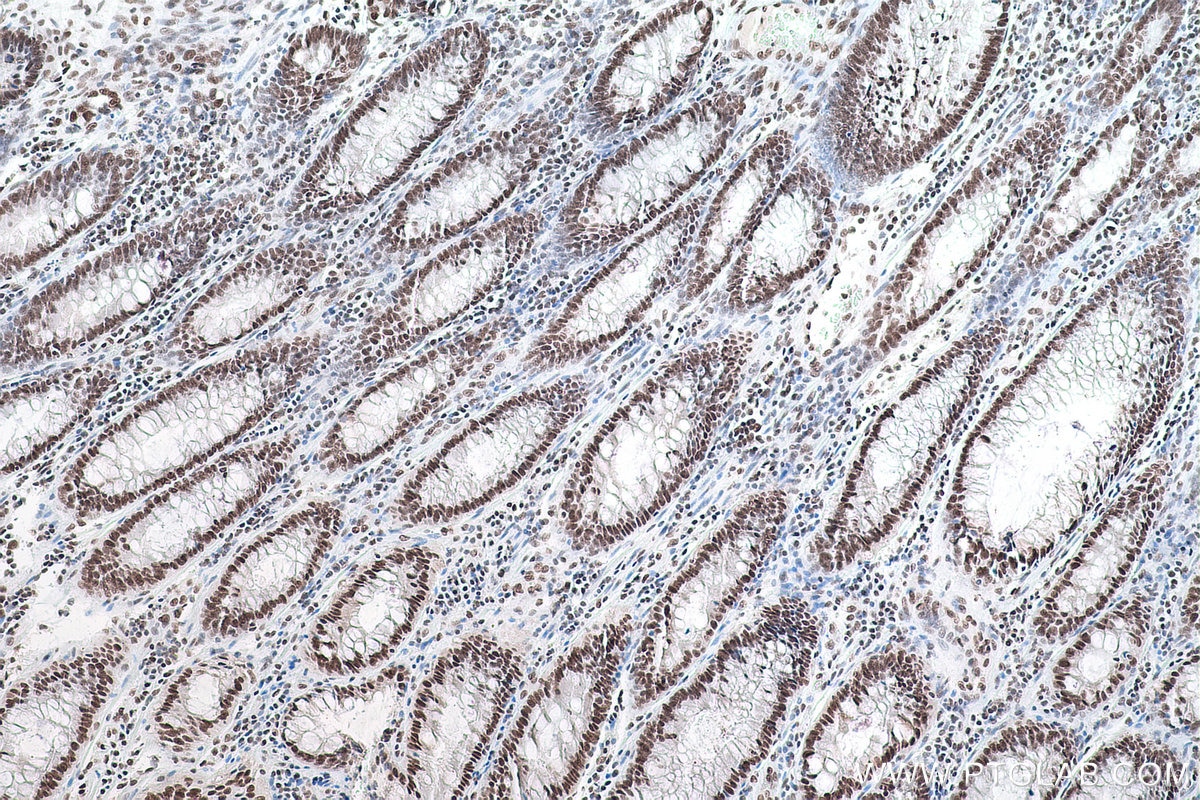 IHC staining of human colon cancer using 10322-1-AP