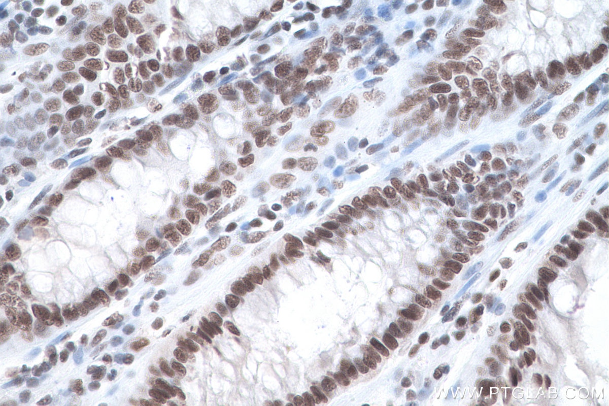 Immunohistochemistry (IHC) staining of human colon cancer tissue using NUDT21 Polyclonal antibody (10322-1-AP)