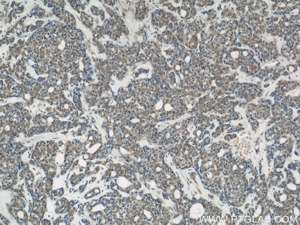 Immunohistochemistry (IHC) staining of human cervical cancer tissue using NUDT21 Polyclonal antibody (10322-1-AP)