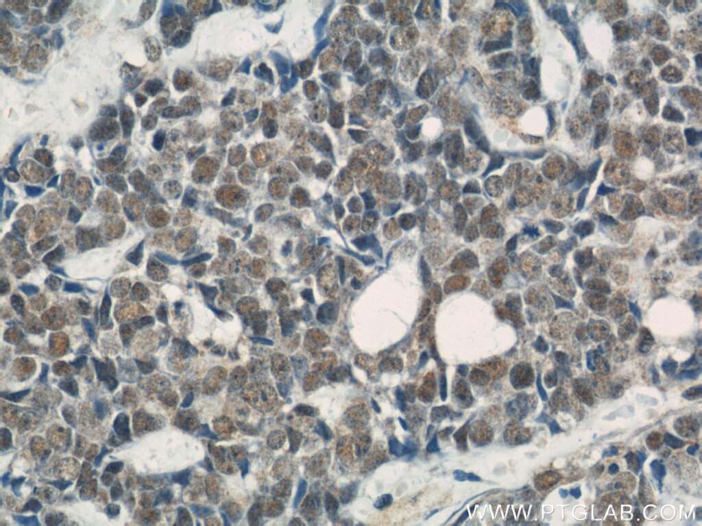 Immunohistochemistry (IHC) staining of human cervical cancer tissue using NUDT21 Polyclonal antibody (10322-1-AP)