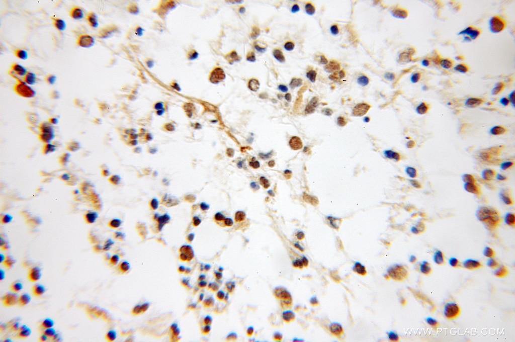 IHC staining of human gliomas using 11181-1-AP