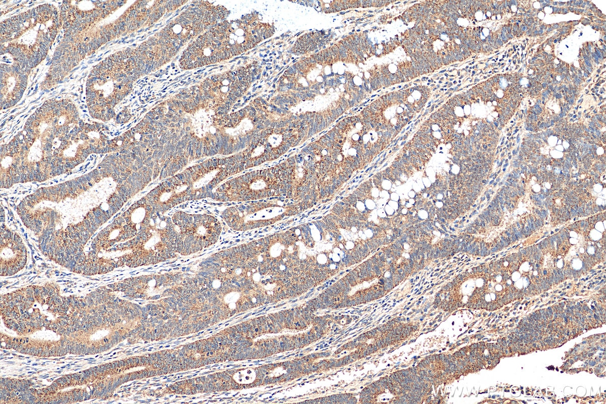Immunohistochemistry (IHC) staining of human colon cancer tissue using NUDT8 Polyclonal antibody (16098-1-AP)