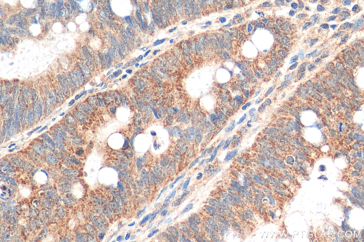 Immunohistochemistry (IHC) staining of human colon cancer tissue using NUDT8 Polyclonal antibody (16098-1-AP)