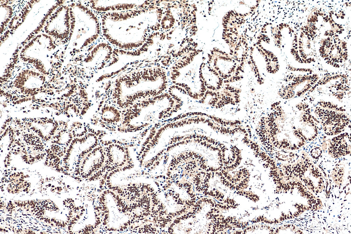 Immunohistochemistry (IHC) staining of human ovary tumor tissue using NUFIP1 Polyclonal antibody (12515-1-AP)