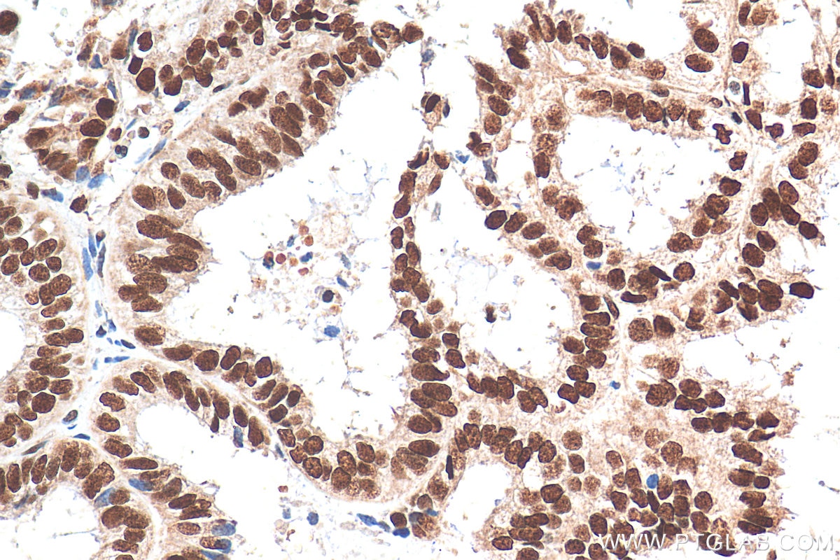 Immunohistochemistry (IHC) staining of human ovary tumor tissue using NUFIP1 Polyclonal antibody (12515-1-AP)