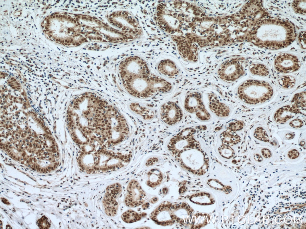 Immunohistochemistry (IHC) staining of human breast cancer tissue using NuMA Polyclonal antibody (16607-1-AP)