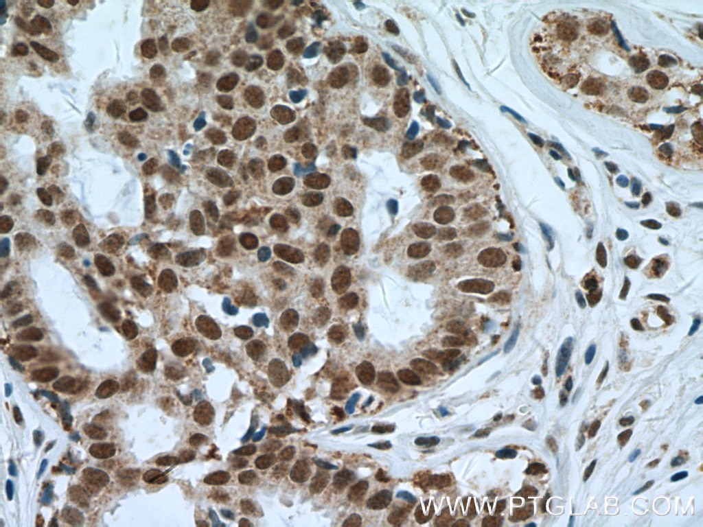 Immunohistochemistry (IHC) staining of human breast cancer tissue using NuMA Polyclonal antibody (16607-1-AP)