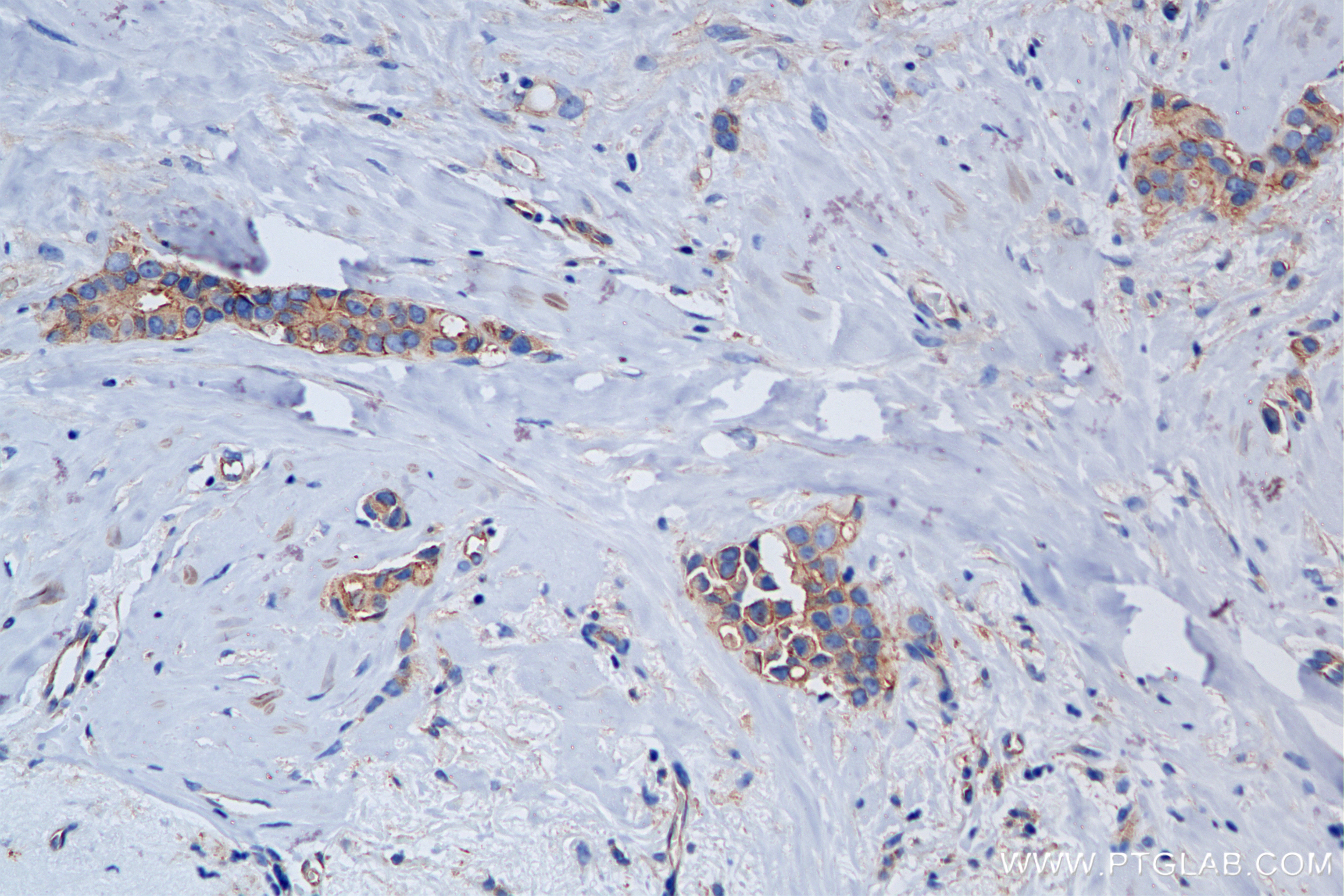Immunohistochemistry (IHC) staining of human breast cancer tissue using NUMB Recombinant antibody (85939-4-RR)