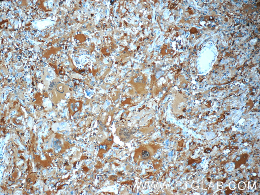 Immunohistochemistry (IHC) staining of human gliomas tissue using NUMBL Polyclonal antibody (10111-1-AP)