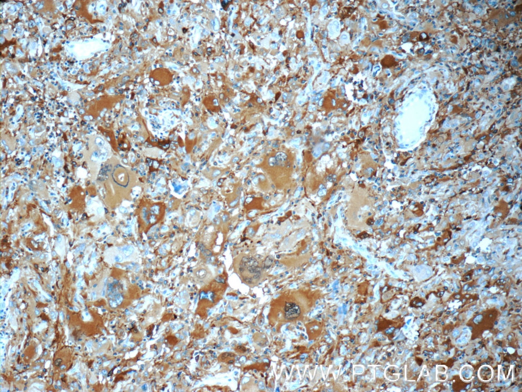 IHC staining of human gliomas using 10111-1-AP