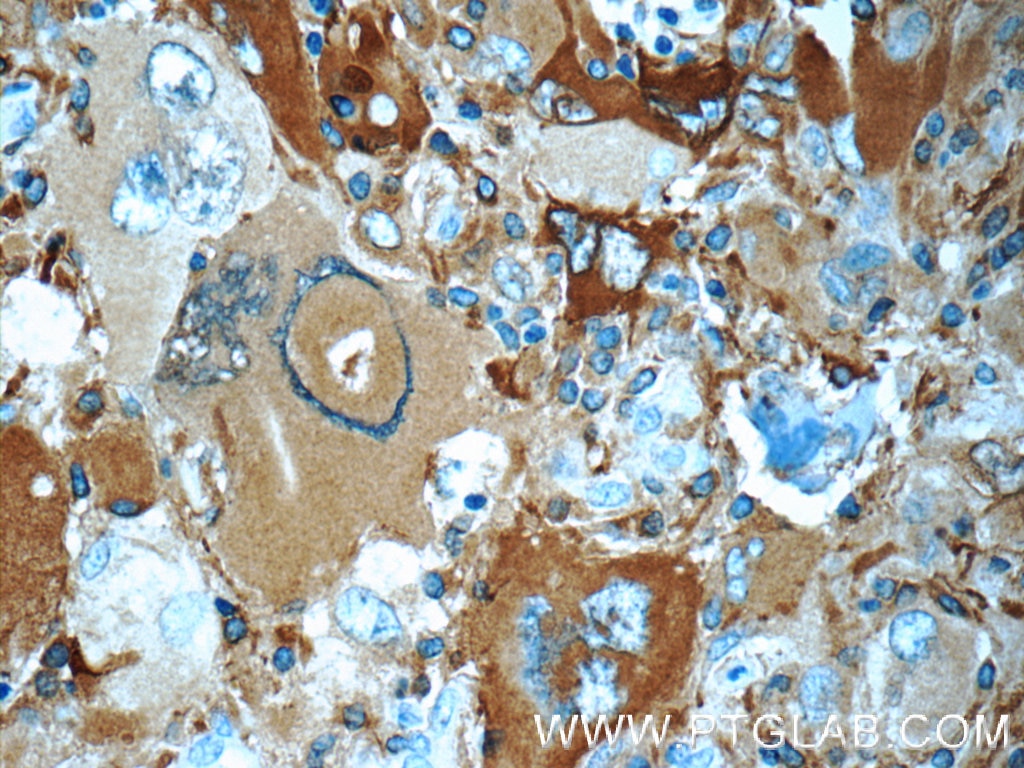 Immunohistochemistry (IHC) staining of human gliomas tissue using NUMBL Polyclonal antibody (10111-1-AP)