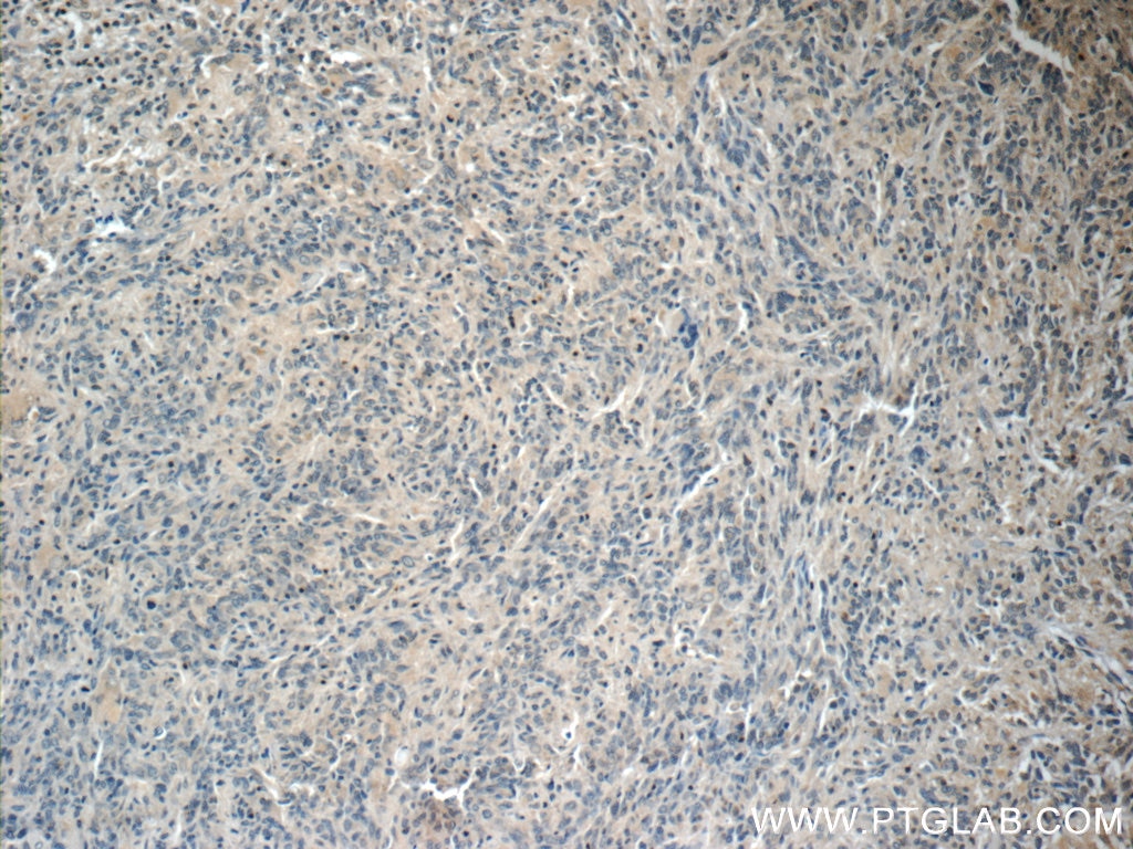 Immunohistochemistry (IHC) staining of human gliomas tissue using NUMBL Monoclonal antibody (66155-1-Ig)