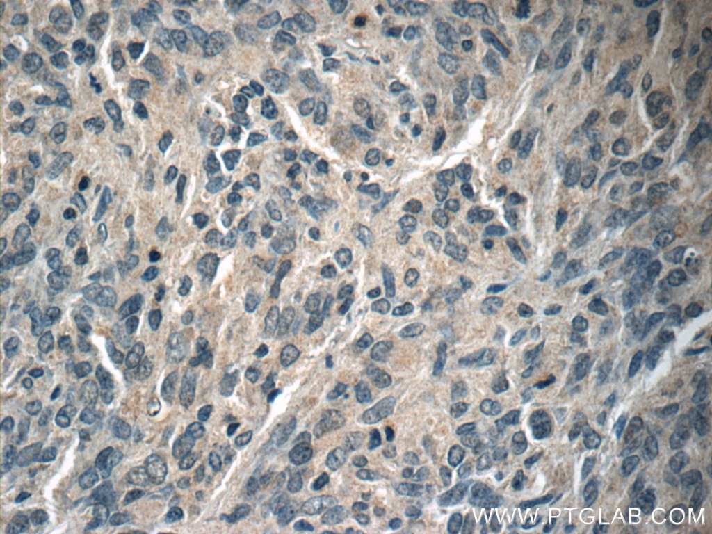 Immunohistochemistry (IHC) staining of human gliomas tissue using NUMBL Monoclonal antibody (66155-1-Ig)